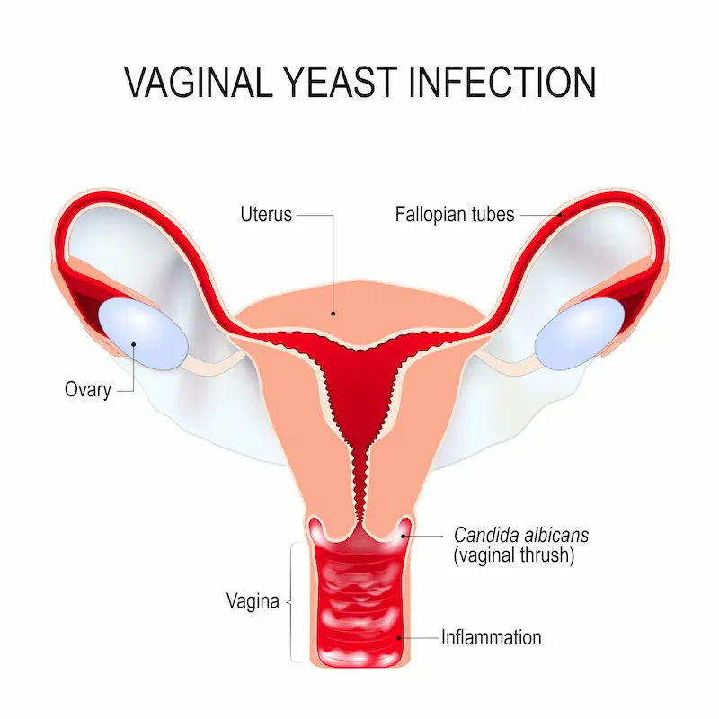 What Leads to Signs of a Vaginal Yeast Infection